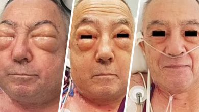 Фото - После операции на легком пожилой австралиец стал похож на Вия