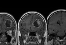 Фото - Ученые создали метод диагностики опухоли мозга, позволяющий изучить ее характер за 40 минут