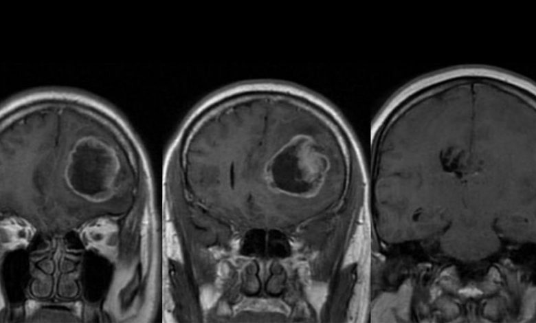 Фото - Ученые создали метод диагностики опухоли мозга, позволяющий изучить ее характер за 40 минут