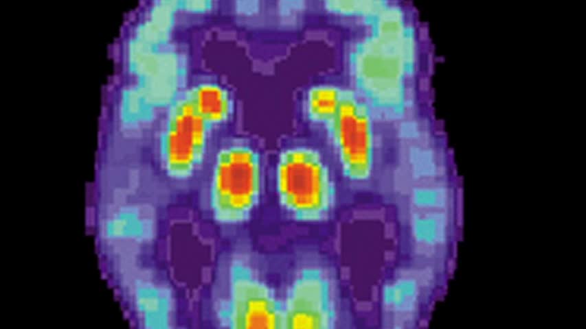 Фото - Подтверждена альтернативная гипотеза о болезни Альцгеймера